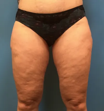 Liposuction Case #281 — after, Dr. Samir Rao