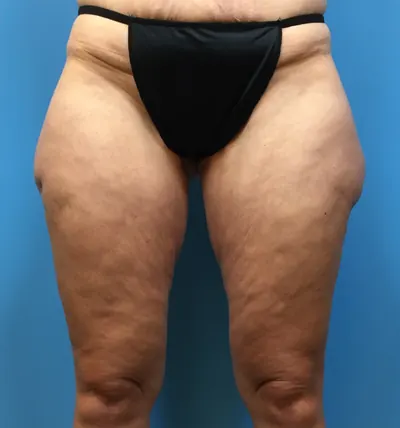 Liposuction Case #281 — before, Dr. Samir Rao