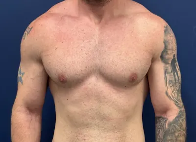 Gynecomastia / Male Breast Reduction Case #28230 — after, Dr. Samir Rao