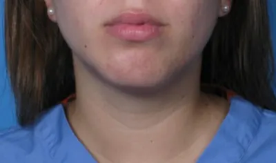 Submental Liposuction Case #293 — after, Dr. Samir Rao