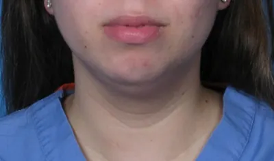 Submental Liposuction Case #293 — before, Dr. Samir Rao