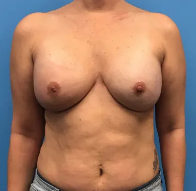 Breast Reconstruction Case #299 — after, Dr. Samir Rao