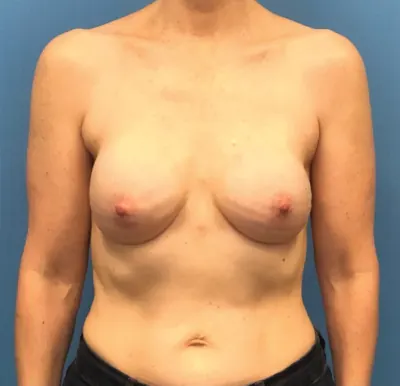 Breast Reconstruction Case #301 — after, Dr. Samir Rao