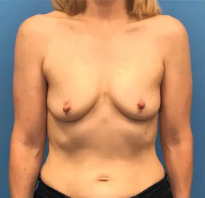 Breast Reconstruction Case #301 — before, Dr. Samir Rao