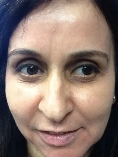 Non-Surgical Case #36 — after, Center for Plastic Surgery