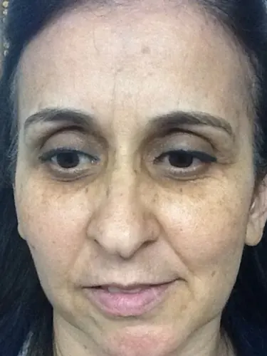 Non-Surgical Case #36 — before, Center for Plastic Surgery