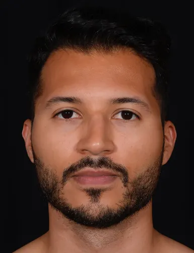 Male Rhinoplasty Case #379 — before, Dr. Arjun Kanuri