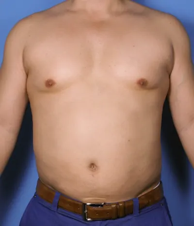 Liposuction Case #389 — after, Dr. Samir Rao