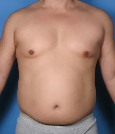 Liposuction Case #389 — before, Dr. Samir Rao