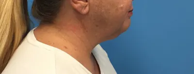 Submental Liposuction Case #391 — after, Dr. Samir Rao