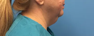 Submental Liposuction Case #391 — before, Dr. Samir Rao