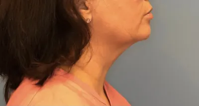 Submental Liposuction Case #392 — after, Dr. Samir Rao