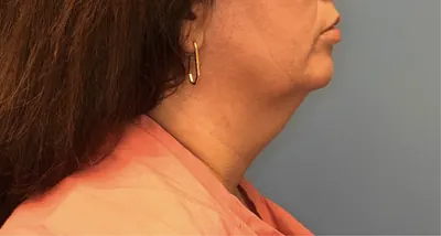 Submental Liposuction Case #392 — before, Dr. Samir Rao