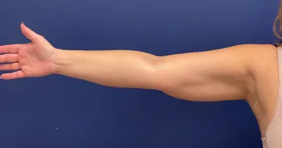 Liposuction Case #399 — after, Dr. Samir Rao