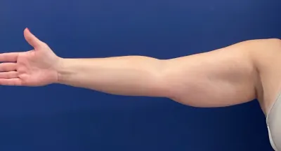 Liposuction Case #399 — before, Dr. Samir Rao