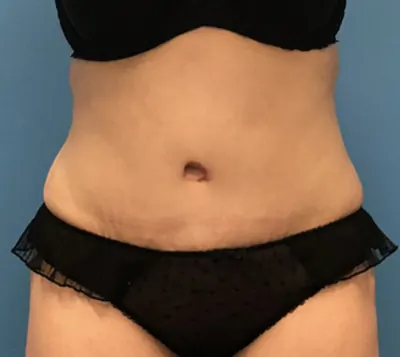 Tummy Tuck Case #56 — after, Dr. Samir Rao
