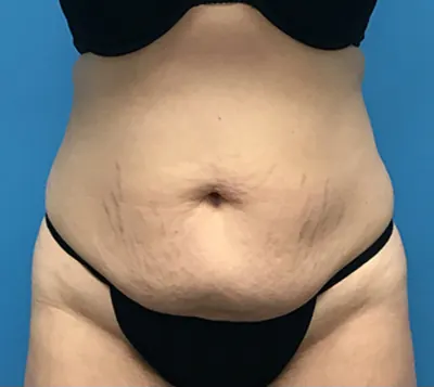 Tummy Tuck Case #56 — before, Dr. Samir Rao