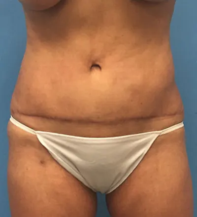 Tummy Tuck Case #65 — after, Dr. Samir Rao