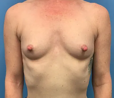 Breast Augmentation Case #88 — before, Dr. Samir Rao