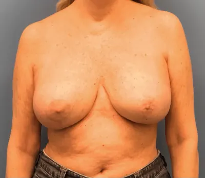 Breast Reconstruction Case #9690 — after, Dr. Samir Rao