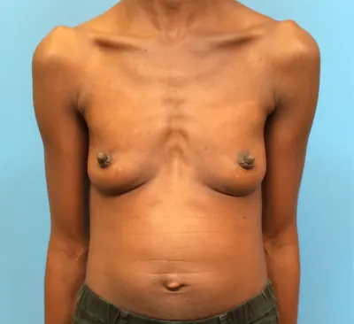 Breast Augmentation Case #97 — before, Dr. Samir Rao