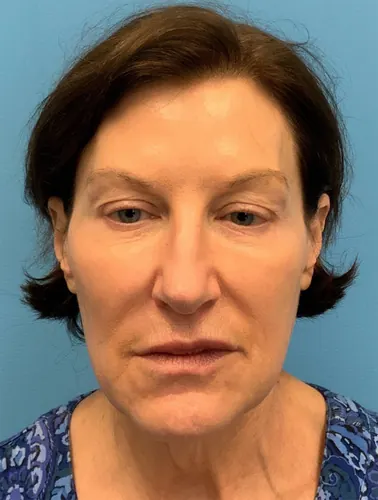 Facelift Case #9966 — before, Dr. Arjun Kanuri