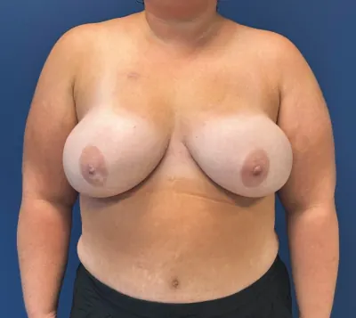DIEP Flap Case #2 — after, Dr. Samir Rao