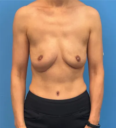 DIEP Flap Case #3 — after, Dr. Samir Rao