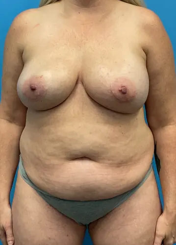 DIEP Flap Case #2056 — before, Dr. Frank Albino