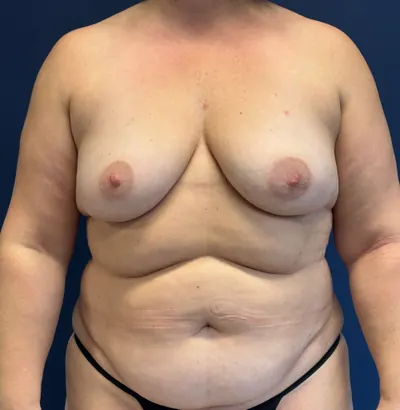 DIEP Flap Case #1682 — before, Dr. Frank Albino