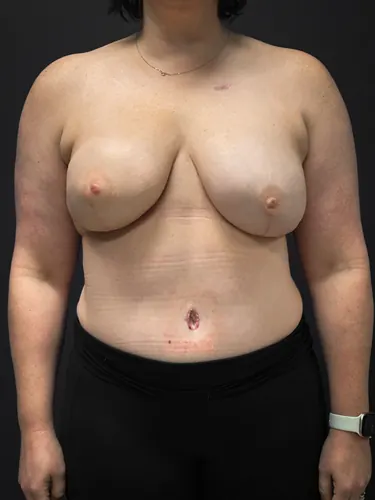 DIEP Flap Case #2980 — after, Dr. Frank Albino