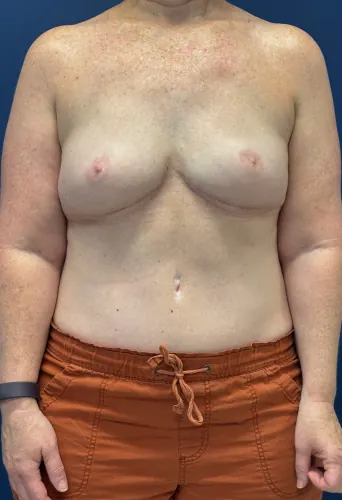 DIEP Flap Case #3138 — after, Dr. Frank Albino