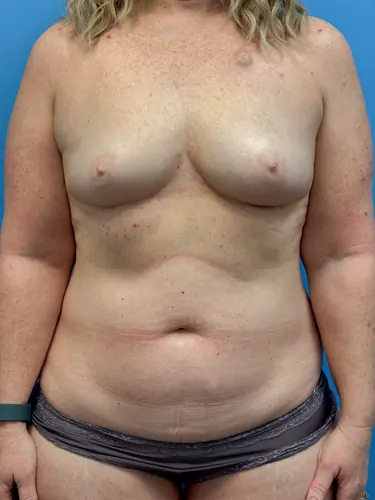 DIEP Flap Case #3138 — before, Dr. Frank Albino
