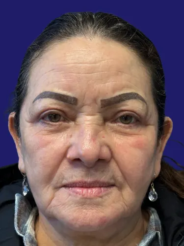 Eyelid Surgery Case #7305178 — after, Dr. Frank Albino