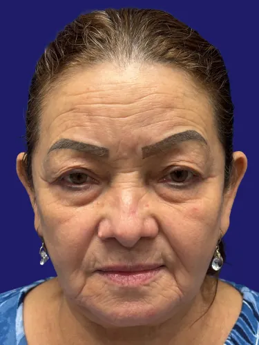 Eyelid Surgery Case #7305178 — before, Dr. Frank Albino