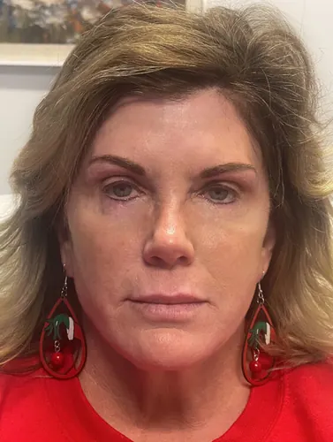 Face360 Case #15055 — after, Dr. Arjun Kanuri