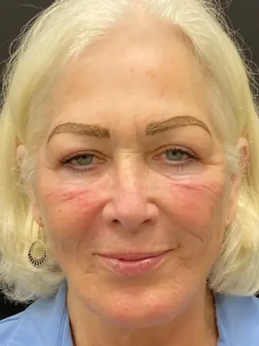 Facelift Case #1975 — after, Dr. Arjun Kanuri