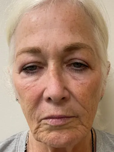 Facelift Case #1975 — before, Dr. Arjun Kanuri