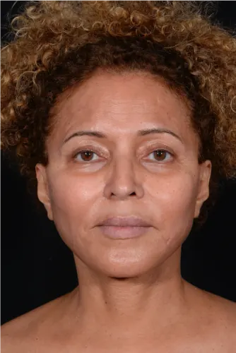 Facelift Case #3772 — after, Dr. Arjun Kanuri