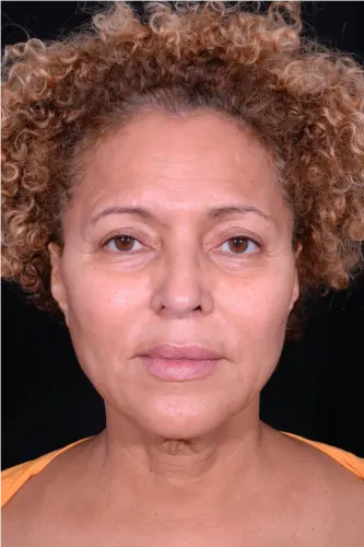 Facelift Case #3772 — before, Dr. Arjun Kanuri
