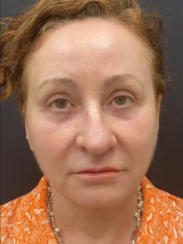 Facelift Case #8423 — after, Dr. Arjun Kanuri