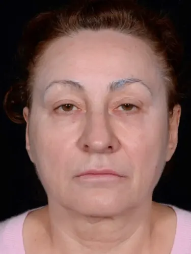 Facelift Case #8423 — before, Dr. Arjun Kanuri