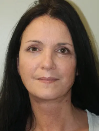 Facelift Case #9403 — after, Dr. Arjun Kanuri