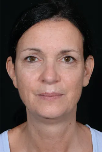 Facelift Case #9403 — before, Dr. Arjun Kanuri