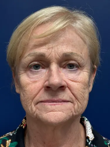 Face360 Case #1433 — before, Dr. Arjun Kanuri