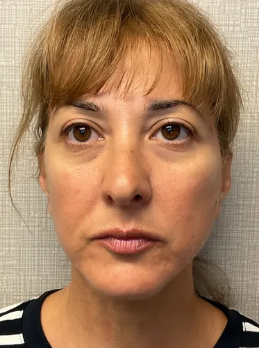 Face360 Case #6190 — after, Dr. Arjun Kanuri