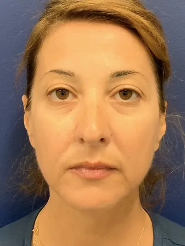 Face360 Case #6190 — before, Dr. Arjun Kanuri