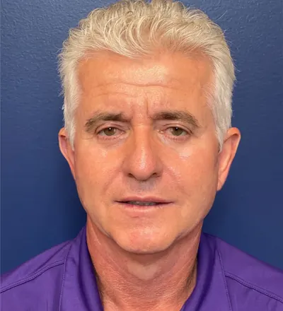 Male Facelift Case #291 — after, Dr. Samir Rao