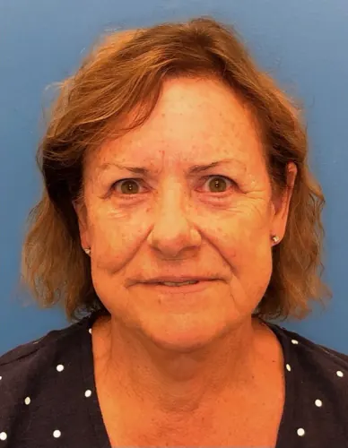 Eyelid Surgery Case #14406 — after, Dr. Samir Rao