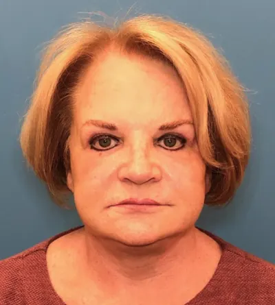 Facelift Case #14460 — after, Dr. Samir Rao